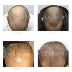 Foligain Advanced Hair Regrowth Treatment Foam For Men with Minoxidil 5% Matu augšanas putas vīriešiem 3 Mēnešiem