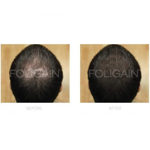 Foligain Advanced Hair Regrowth Treatment Foam For Men with Minoxidil 5% Matu augšanas putas vīriešiem 3 Mēnešiem