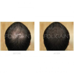 Foligain Advanced Hair Regrowth Treatment Foam For Men with Minoxidil 5% Matu augšanas putas vīriešiem 3 Mēnešiem